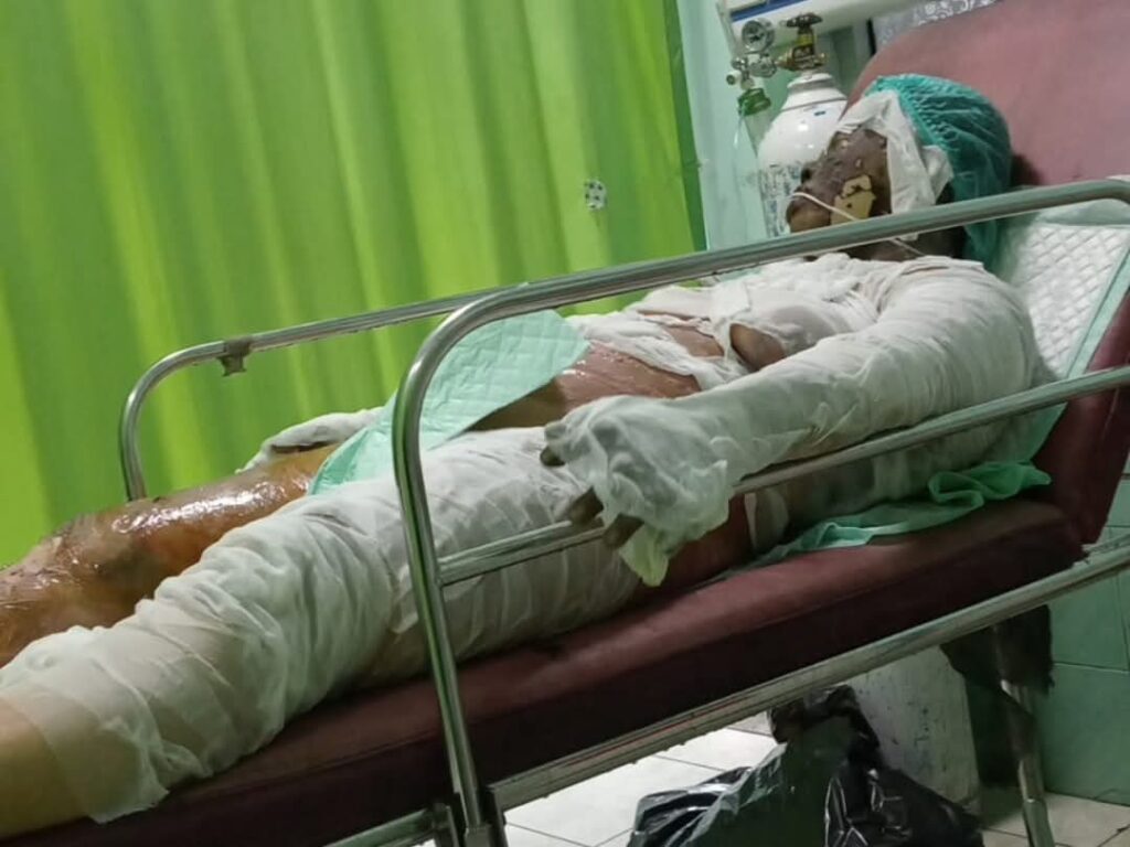 Istri Dibakar Suami di Depan Umum, Tewas dengan Luka Bakar 80 Persen, Polisi: Motif Cemburu, Pelaku Sudah Diamankan